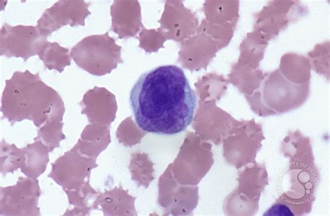 Sezary syndrome - peripheral blood - 2.