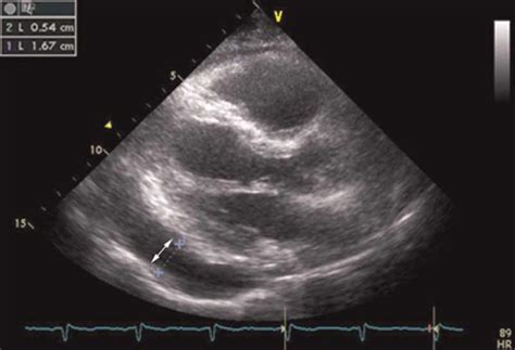 Transthoracic echocardiogram showed pericardial effusion to the... | Download Scientific Diagram