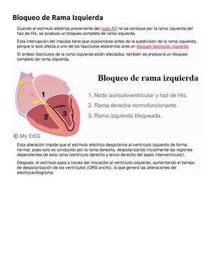 Bloqueo Incompleto de Rama Derecha Criterios electrocardiográficos