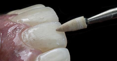 Dt News Mea Predictable Steps To Biomimetic Class Iv Restorations