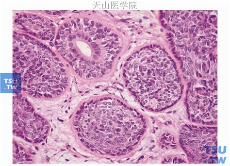 基底细胞腺瘤详细图解（唾液腺良性肿瘤的临床病理） 口腔医学 天山医学院