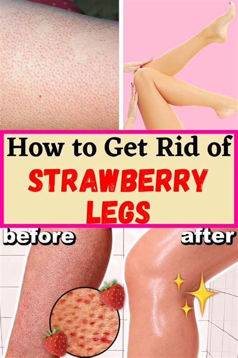 How To Get Rid Of Strawberry Legs Artofit