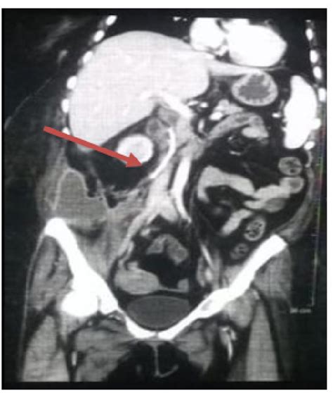 Figure From Management Of Post Endoscopic Retrograde Cholangio