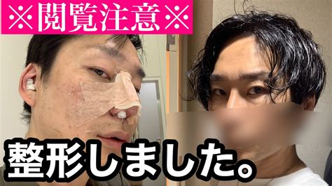 【鼻整形】人生が変わった美容整形のリアル〜before Afterと、壮絶なダウンタイムなど〜【グロ注意】 Youtube