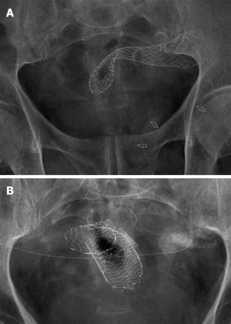 Pdf Colorectal Stenting As First Line Treatment In Acute Colonic