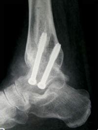 Ankle Fusion Surgery - London Foot and Ankle Centre