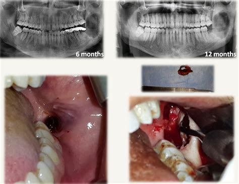 Maxillary Sinus Polyps Cysts