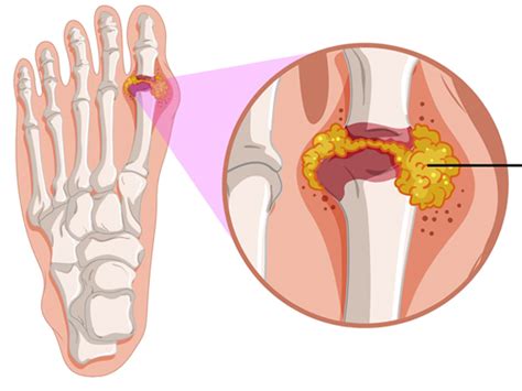 High Uric Acid Symptoms A Comprehensive Guide Tv Health