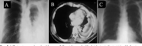 Pdf Open Thoracotomy And Decortication For Chronic Empyema Semantic