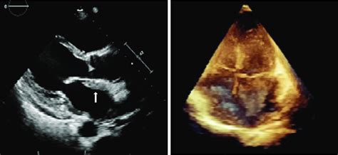 Transthoracic Echocardiography Showed A Homogeneous Isoechoic Layer