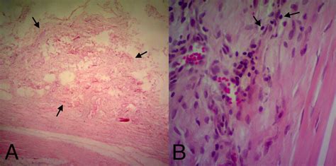 A The Appearance Of Partially Longitudinal Scattered And