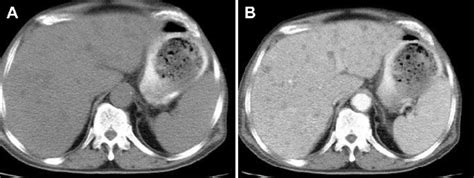 Abdominal Computed Tomography Reveals A Multiple Low Density Lesions Download Scientific