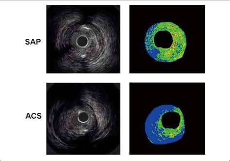 Representative Images Of Conventional Intravascular Ultrasound And