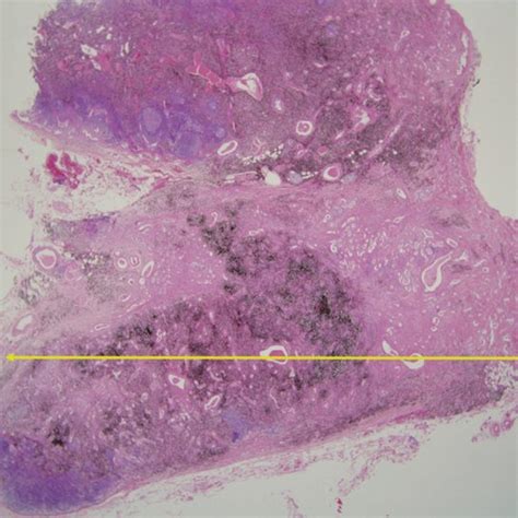 Histologic Findings Of Lymph Node Metastasis In Lung Adenocarcinoma