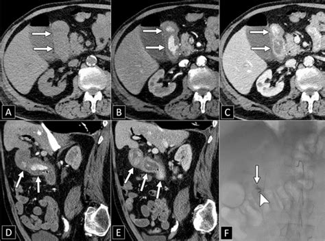 role  imaging  gi bleeding acg  sar consensus