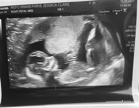 Had My Scan Yesterday At 13 3 Weeks Any Guesses Glow Community