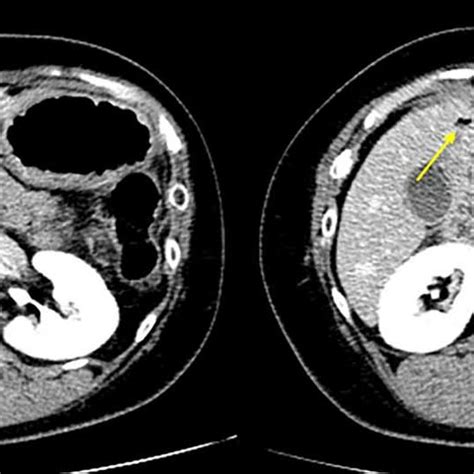 Contrast Enhanced Abdominal Computed Tomography Showing Free Air