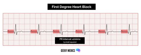 How to read an ECG | ECG Interpretation | Geeky Medics