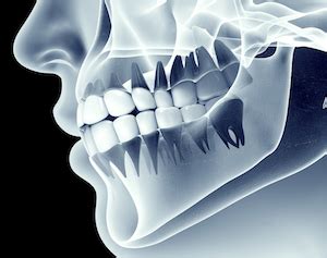 Sinus Pain Or Abscessed Tooth Rotem Dental Care