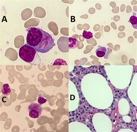 Neoplastic Plasma Cells With Auer Rod‐like Inclusions Jakob 2020