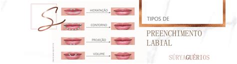 Tipos De Preenchimento Labial Dra Surya