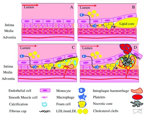 Atherosclerotic Plaque Formation A Normal Vessel B Atherogenesis Download Scientific