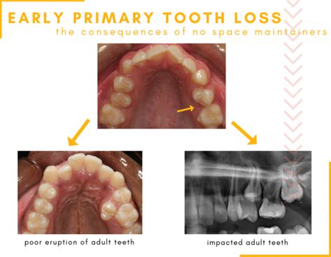 Early Tooth Loss in Children | Hometown Orthodontics