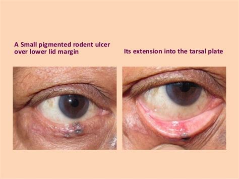 Malignant Eyelid Tumours