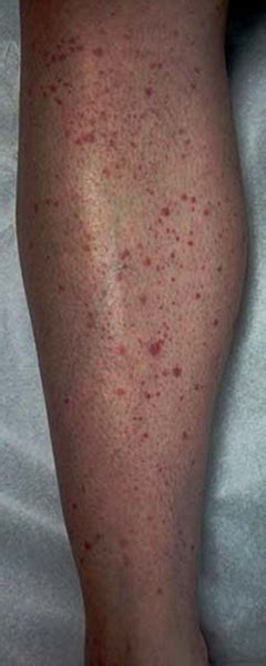 Vasculitis Rash Pictures – the meta pictures