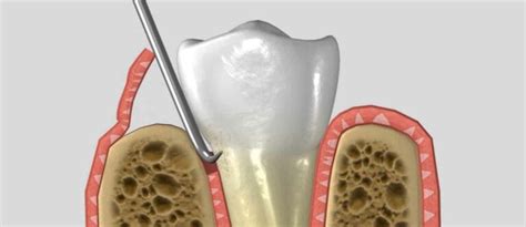 Gum Flap Surgery American River Dental Rancho Cordova Dentist