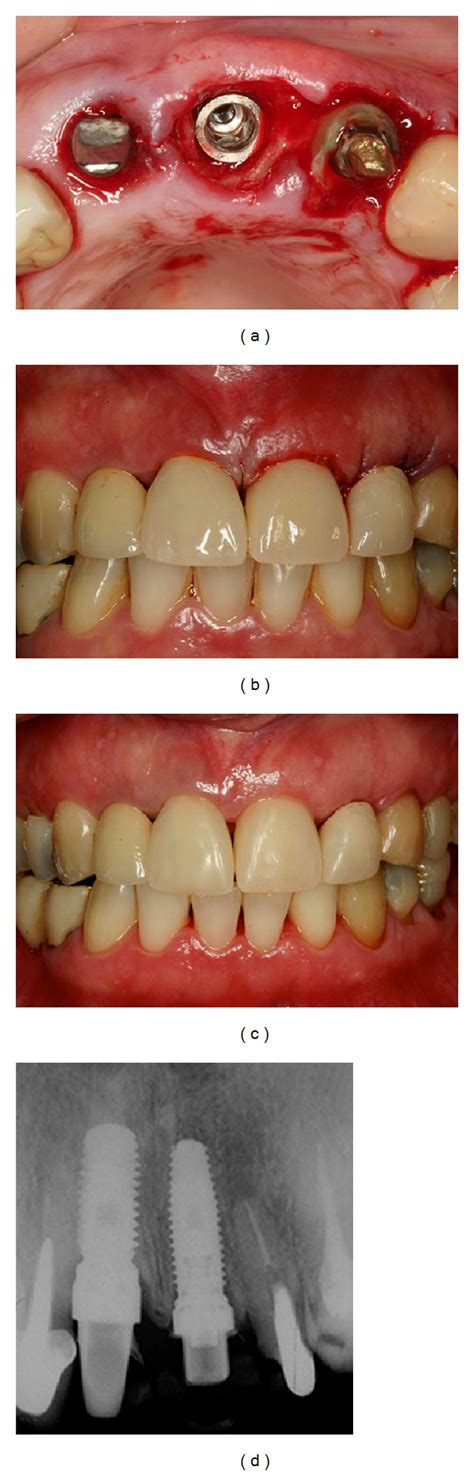 Correction Of Malpositioned Implants Through Periodontal Surgery And