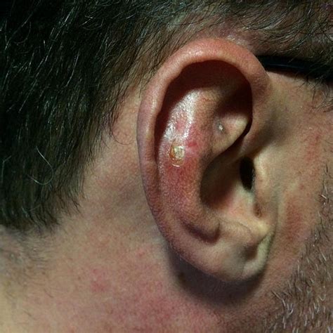 Cancer Of The External Ear Types Symptoms Staging And Treatment