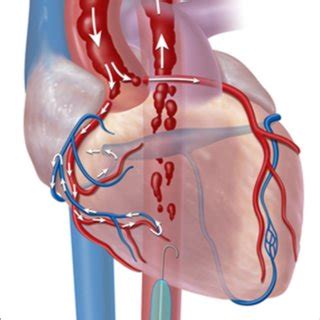 Classification Of Aortic Zone Using Resuscitative Endovascular