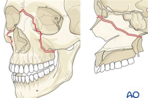 A Dental Student S Guide To Le Fort Fractures Dentistry