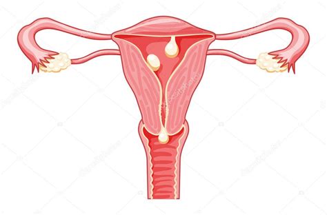 Polipi Nell Utero Sistema Riproduttivo Femminile Cervicale Peduncolato