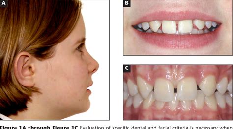 Figure 1 From Managing Congenitally Missing Lateral Incisors Part 1