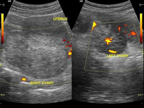 Ovarian Torsion