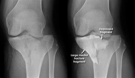 Anterior Tibial Plateau Fracture