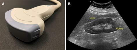 Point Of Care Renal Ultrasonography For The Busy Nephrologist A