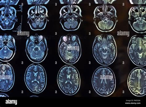 Magnetic resonance image scan of the brain. MRI film of a human skull ...