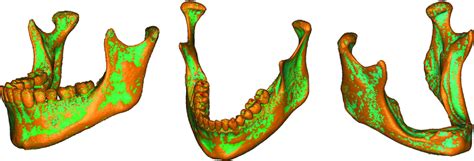 Finite Element Analysis Of The Human Mandible At 3 Different Stages Of