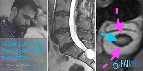 SPINE MRI NERVE ROOT COMPRESSION ONLINE RADIOLOGY COURSE - Radedasia