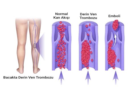 Derin Ven Trombozu Belirtileri İngiliz Tuzu ve Sağlık