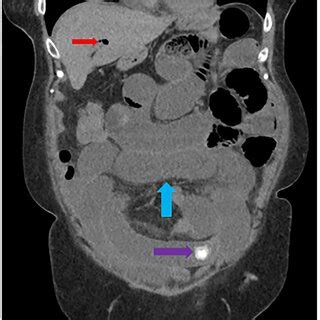 Right upper quadrant (RUQ) ultrasound view showing free fluid (FF ...