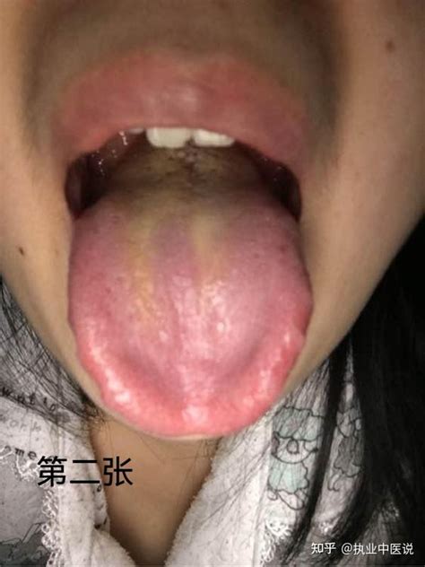 中医舌诊：脾虚湿盛、阴虚内热和脾肾阳虚的舌苔是什么样的？ 知乎