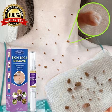 Warts Mole Remover Cream Original Skin Tag Wart Remover Original Kasoy