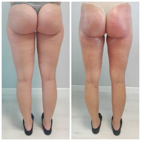 Velashape Before And After Vivalaser For You For All For Beauty