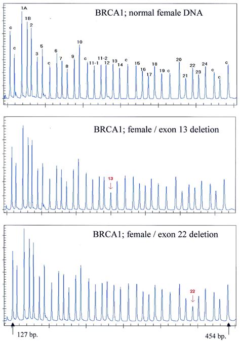 Detection Of BRCA1 Exon Deletions By MLPA Samples Containing 100 Ng