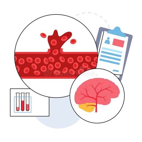 Cerebral Hemorrhage Stock Illustrations 418 Cerebral Hemorrhage Stock