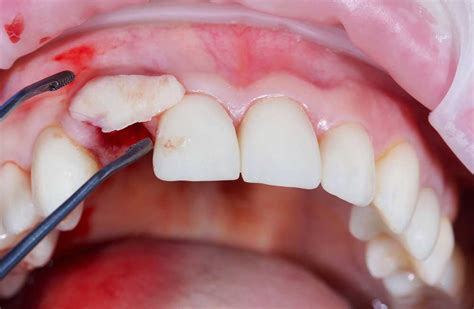 Bone Grafting For Dental Implants An Essential Guide